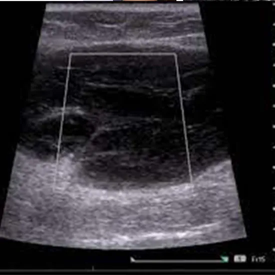 Ultrasound Gluteal Region Test
